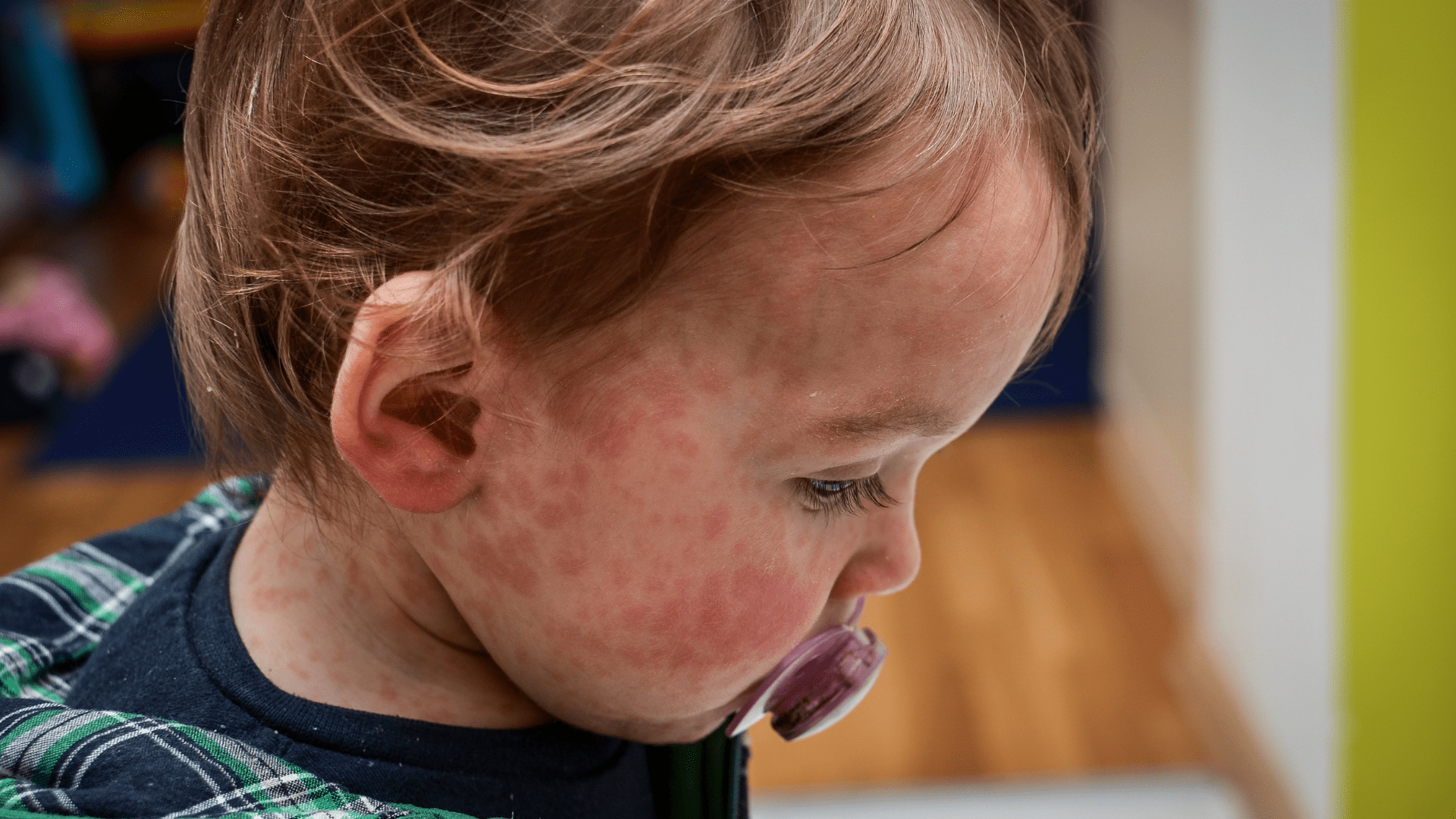 Measles Outbreak: Millions in the UK are Being Urged to Get MMR Vaccine
