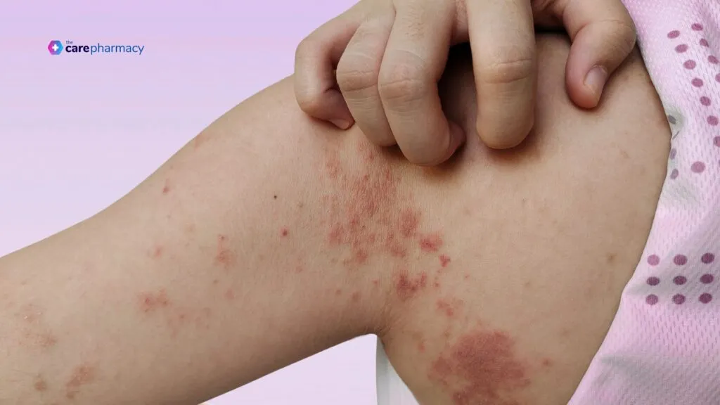Impetigo