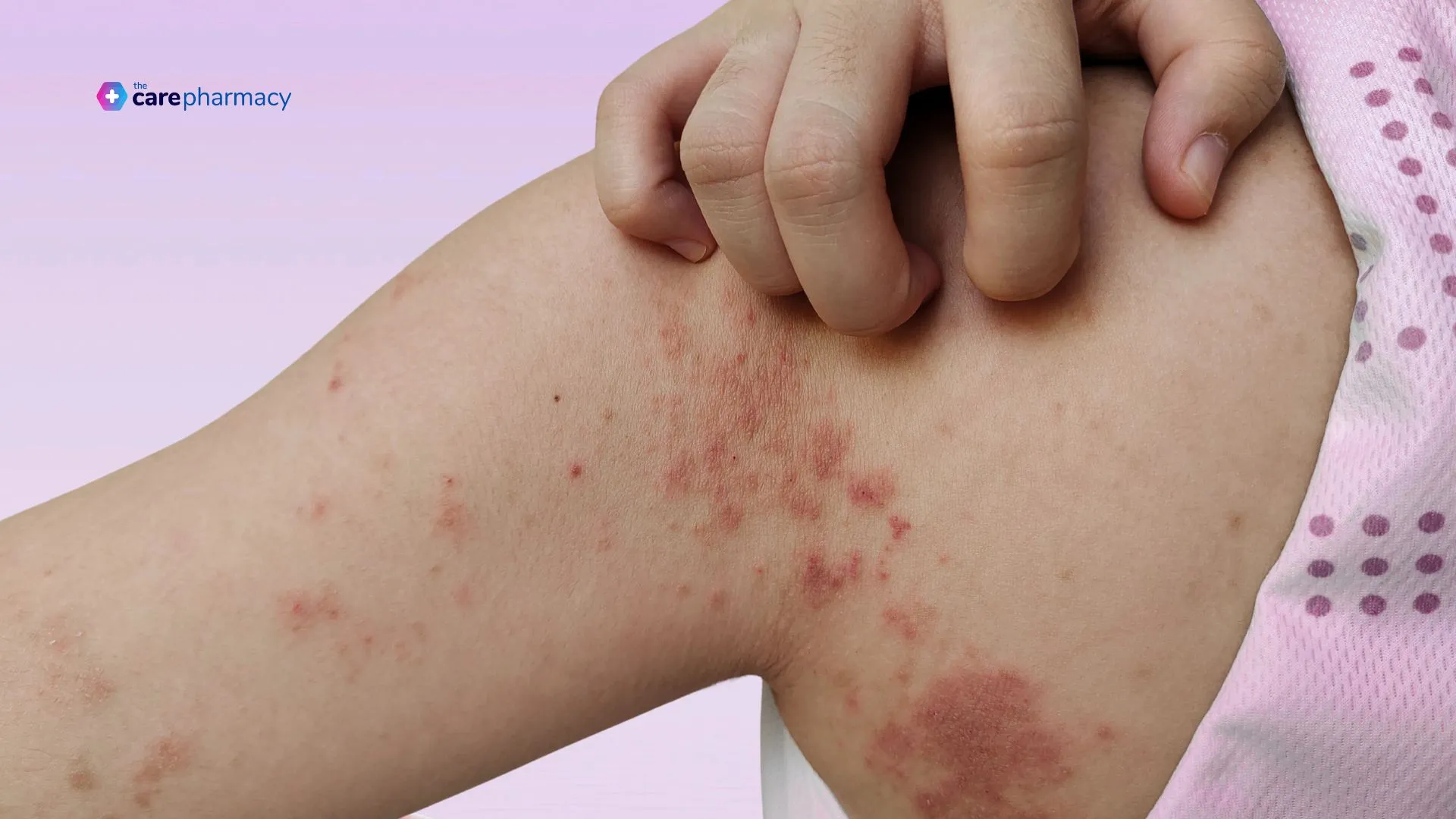 Impetigo on patient's arm