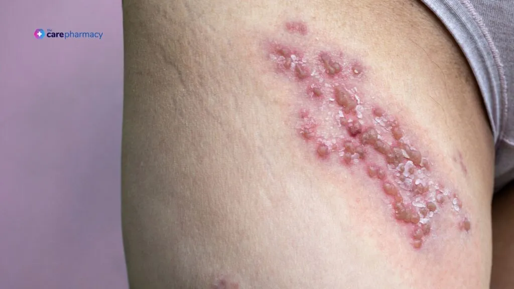 Shingles