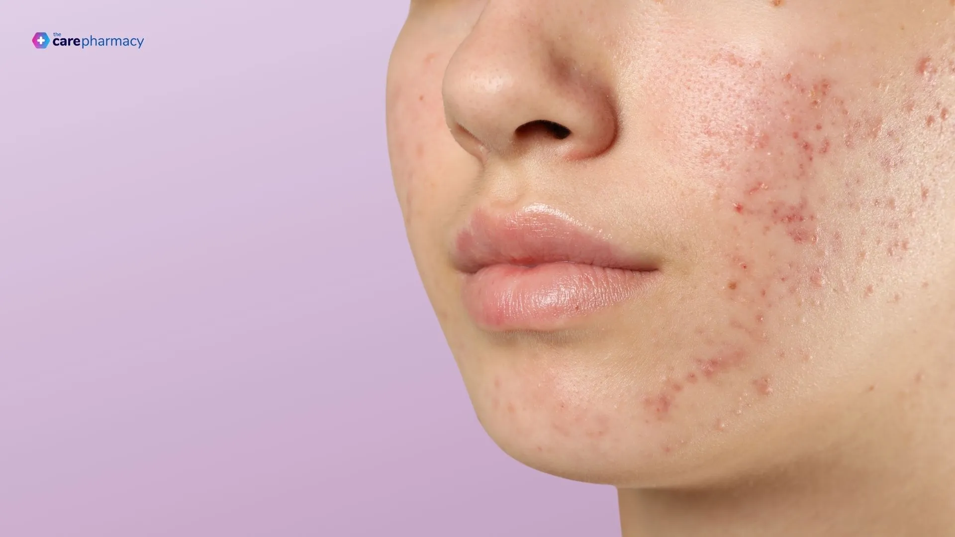 Acne