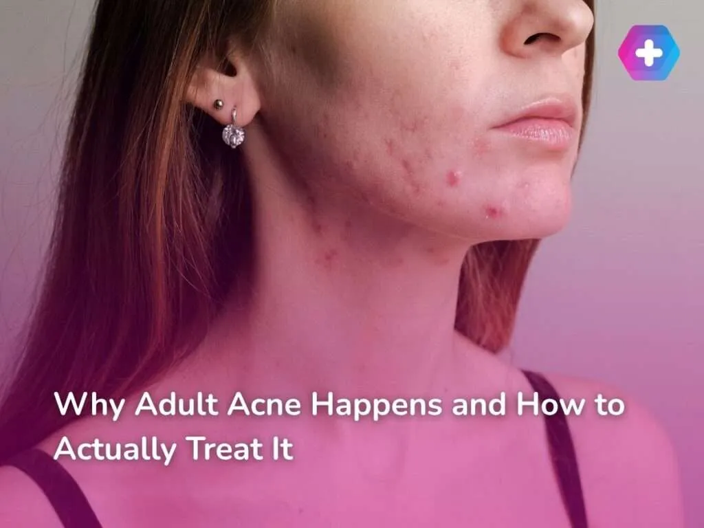 Why Adult Acne Happens and How to Actually Treat It