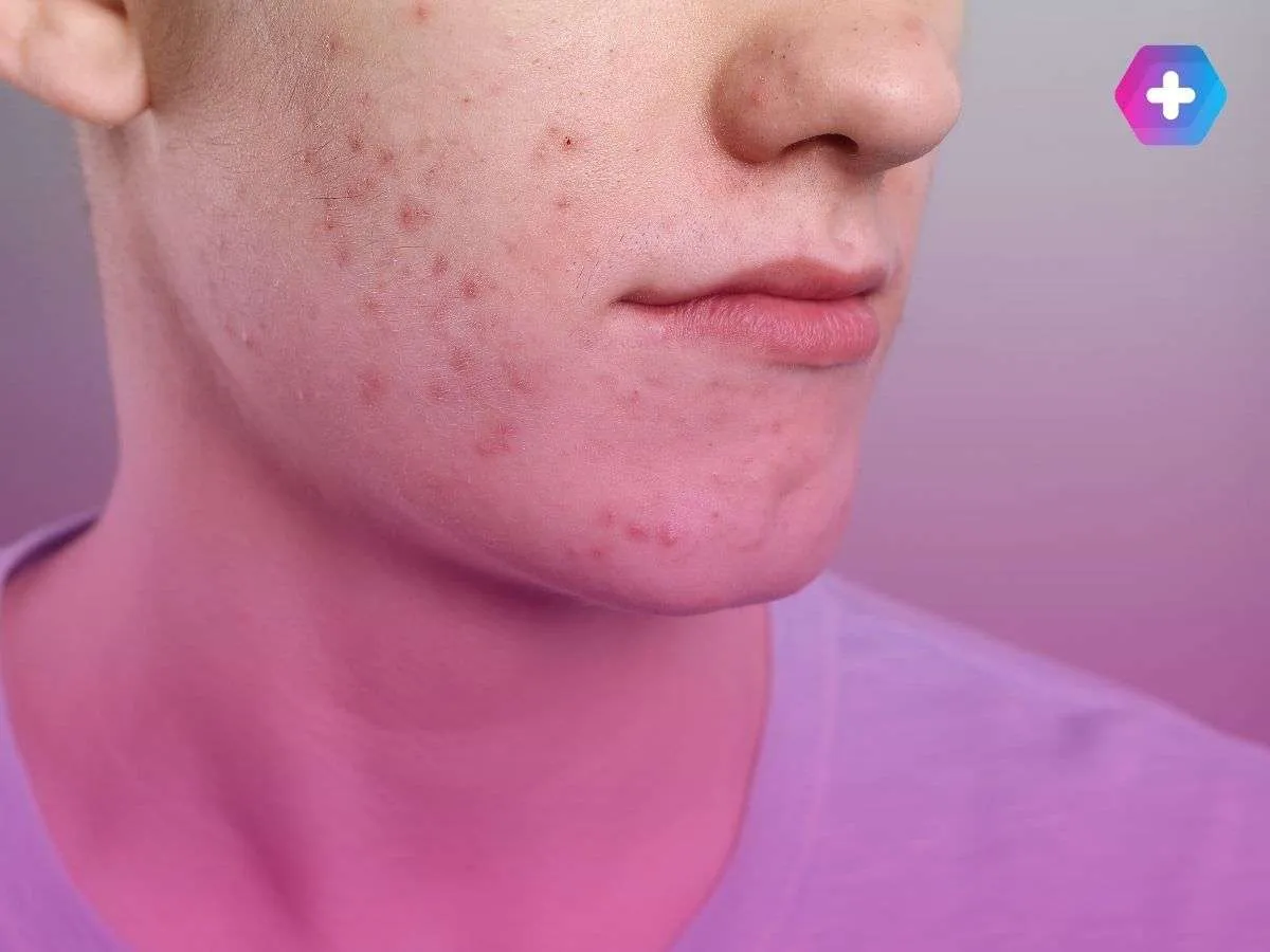 young man with acne on his face